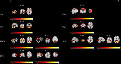 Disrupted intra- and inter-network connectivity in unilateral acute tinnitus with hearing loss